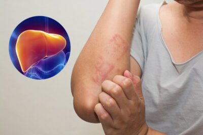 Ngứa ban đêm không phải rôm sảy – Gan bạn đang gửi báo hiệu thầm lặng